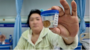蜜蜡状胆囊结石现身贵阳，专家呼吁有这些习惯要警惕