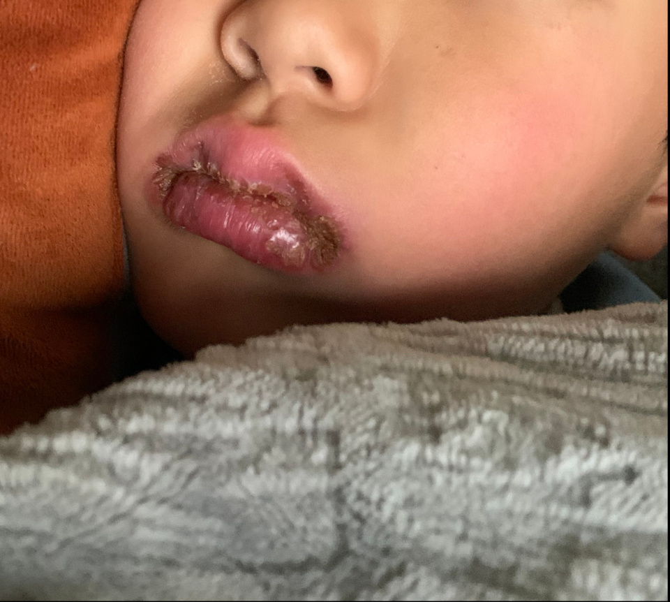 发热、烂嘴角，可能是“唇炎”在作祟，医生提醒：冬季儿童唇炎进入高发期