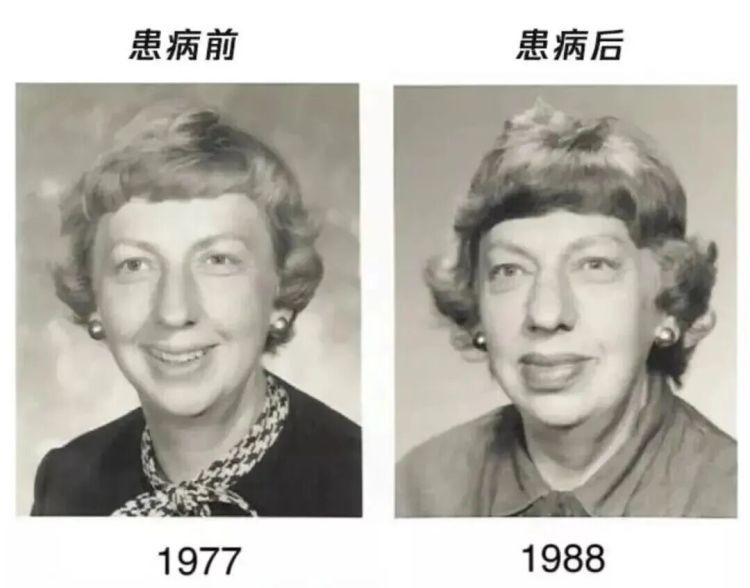 出现这种面相，可能是肿瘤前兆！别以为只是“发福”了