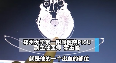 13岁男孩泡澡20分钟脑出血，男性常泡40℃以上热水澡或致不孕不育，医生提醒→