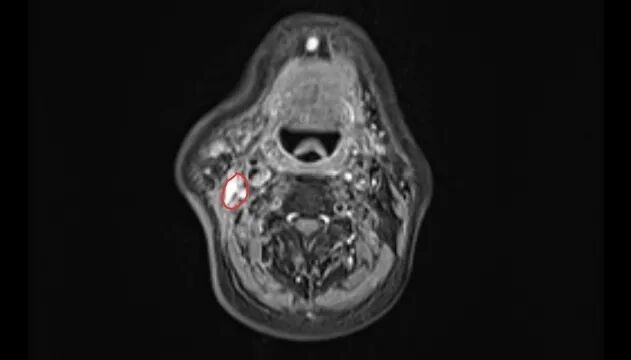 杭州大伯洗脸摸到腮帮有个硬疙瘩，竟是癌转移
