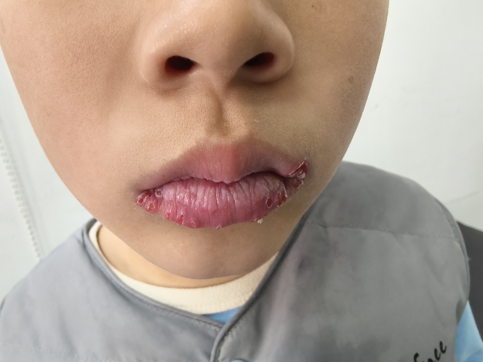发热、烂嘴角，可能是“唇炎”在作祟，医生提醒：冬季儿童唇炎进入高发期