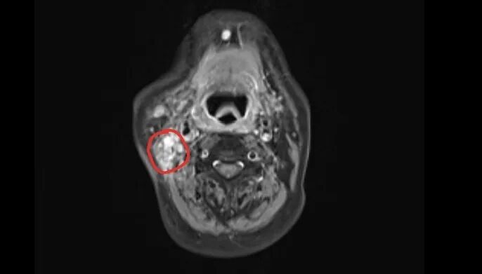 杭州大伯洗脸摸到腮帮有个硬疙瘩，竟是癌转移