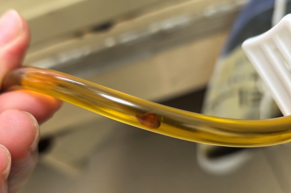 头皮发麻！手术切出大量活虫，罪魁祸首是广东人钟爱的鱼生