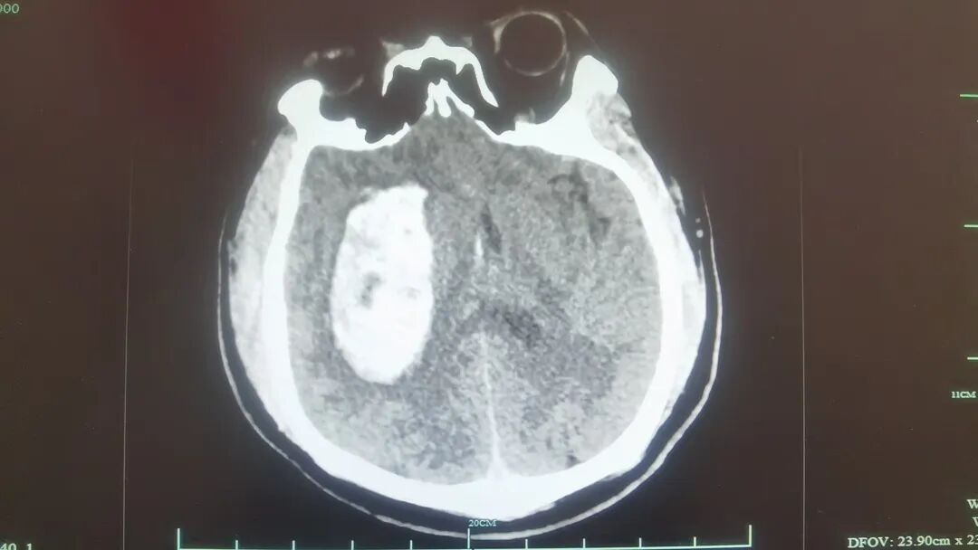 一夜之间！杭州30岁男子血压爆表晕厥，元凶就藏在冬季生活习惯里
