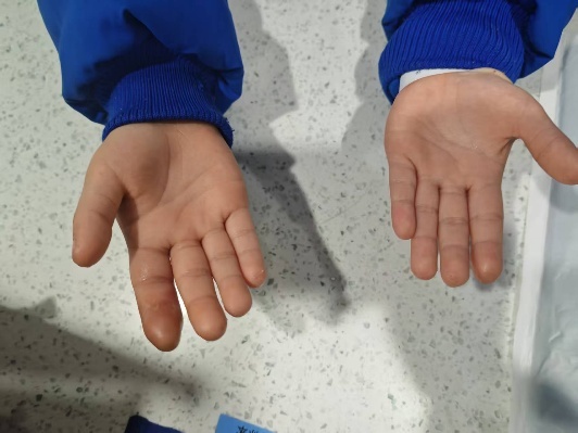 孩子爱咬指甲？当心“咬”出大问题