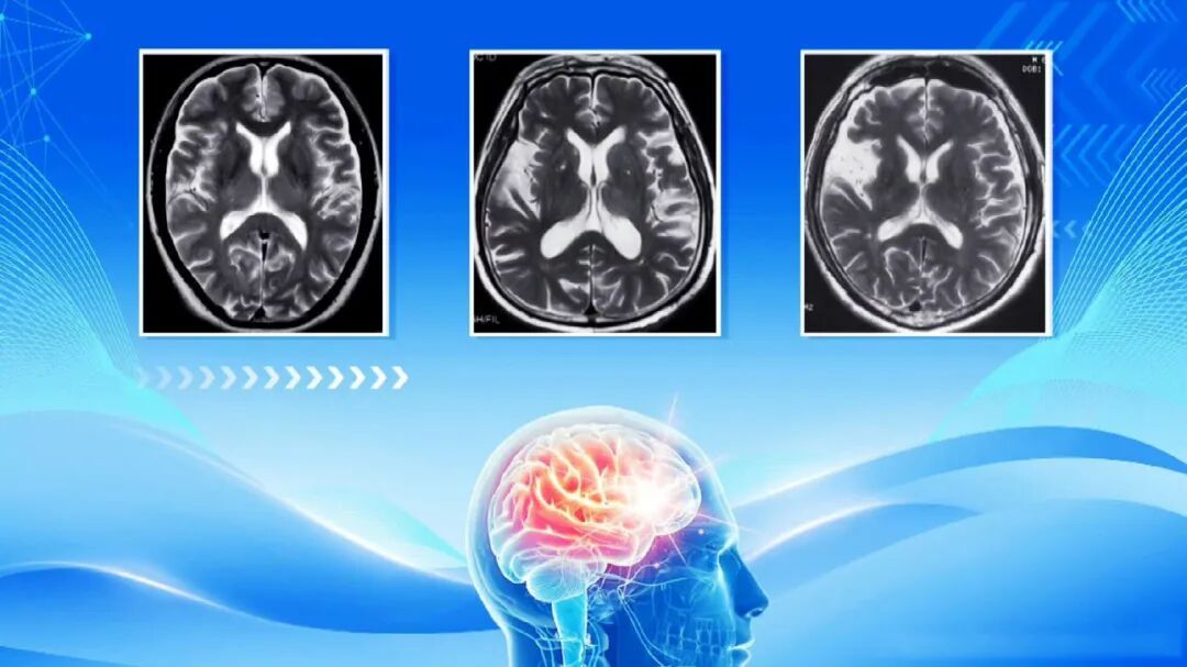 手指出现3个异常，说明脑梗离你很近，别错过抢救时间