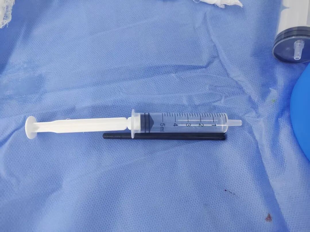 广东一男子被一根筷子从耳部插入颅底，筷子尖距颈内动脉仅5毫米