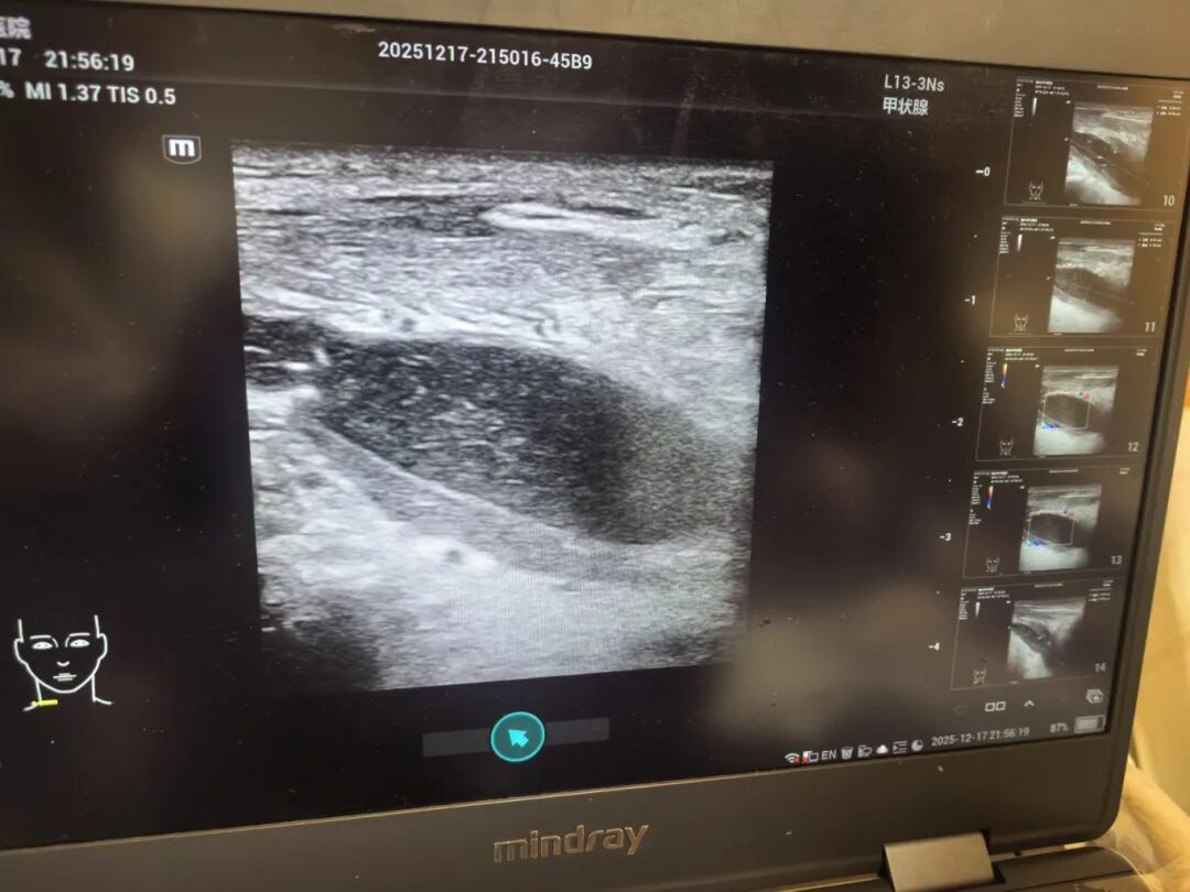 太凶险！福建郑先生被紧急送医抢救！医生：这病致死率高！