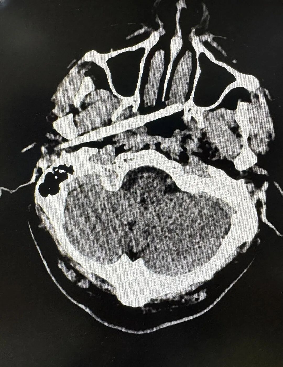 广东一男子被一根筷子从耳部插入颅底，筷子尖距颈内动脉仅5毫米