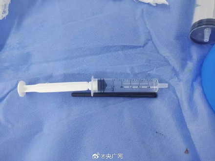 筷子刺入男子颅底 离动脉仅5毫米