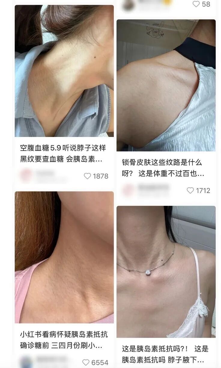 蝌学零距离丨真的想问：脖子上一条条的“黑道道”，是胰岛素抵抗吗？