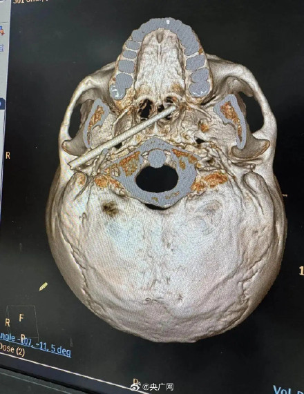 筷子刺入男子颅底 离动脉仅5毫米