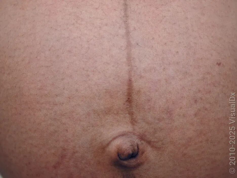 蝌学零距离丨真的想问：脖子上一条条的“黑道道”，是胰岛素抵抗吗？
