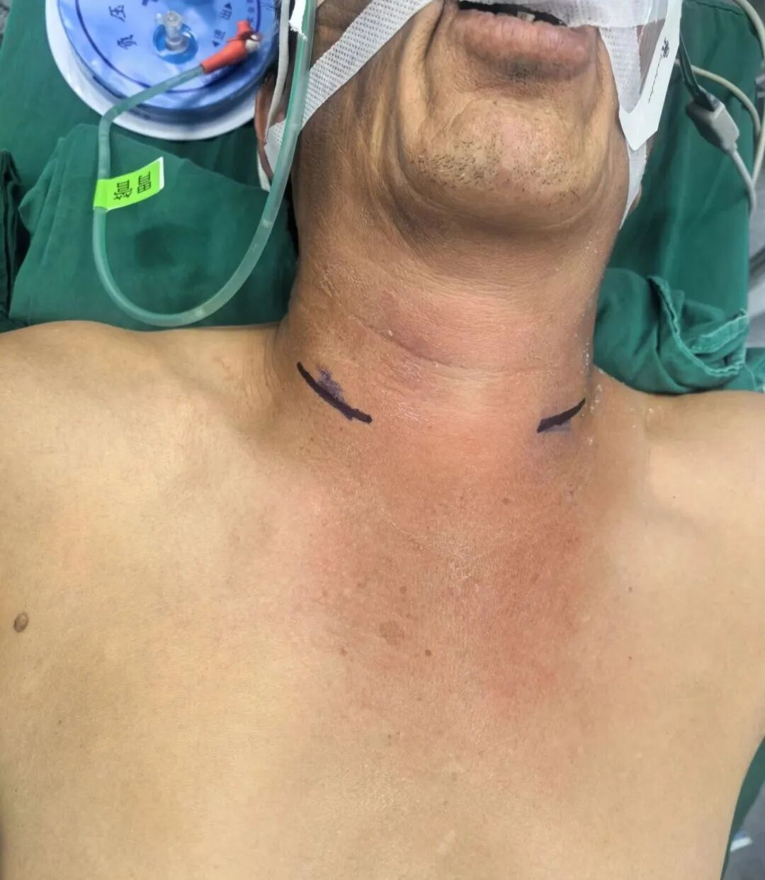 太凶险！福建郑先生被紧急送医抢救！医生：这病致死率高！