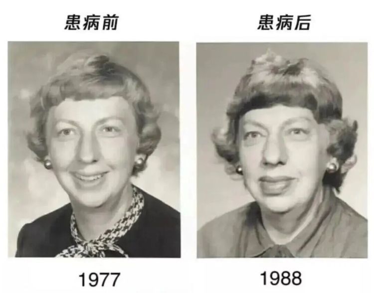 面部出现此种变化可能是恶疾前兆，24岁清秀女子样貌突变，“不爱喝奶茶也没遗传史”