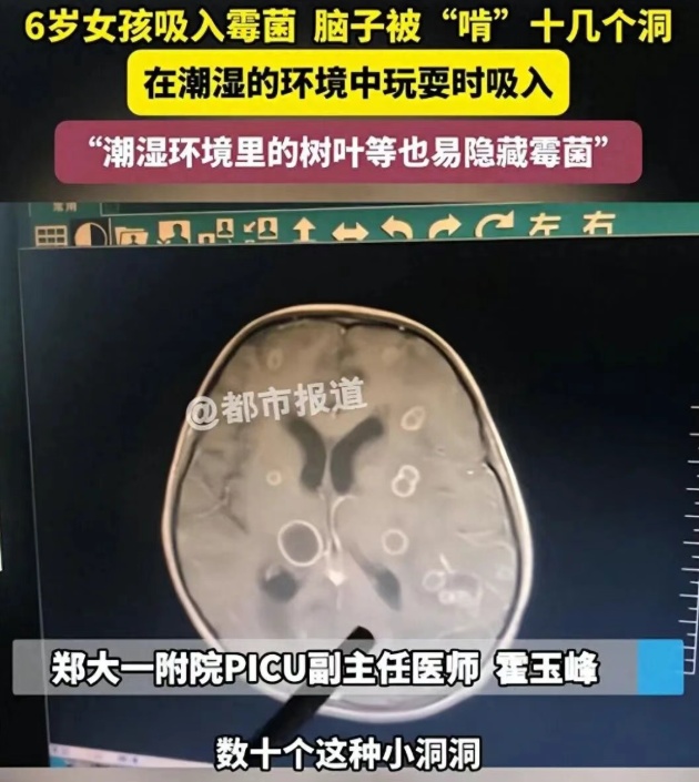 6岁女孩发烧17天，脑子被“啃”出十几个洞！医生：“真凶”很常见