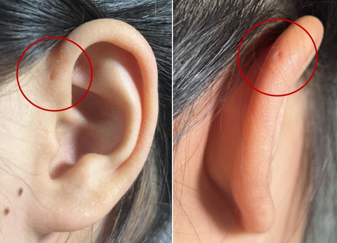 女子因耳朵从小被夸“有福”，却受多年“酷刑”！医生：再拖就晚了