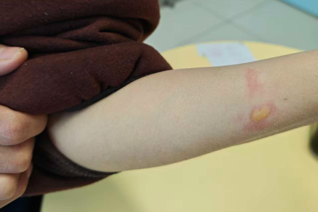 一觉醒来，痛到穿不了衣服！不少人近期中招，这些习惯赶紧改…