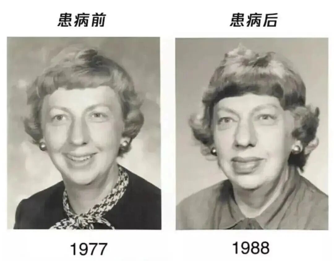 这种面相不是“发福”，可能是肿瘤前兆