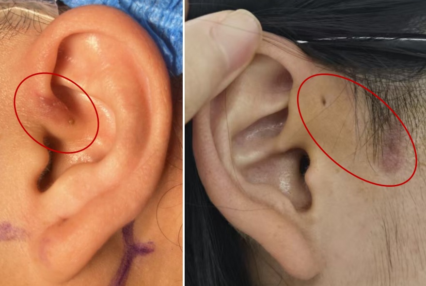 女子因耳朵从小被夸“有福”，却受多年“酷刑”！医生：再拖就晚了