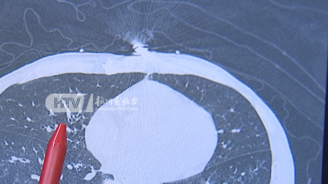 75岁阿姨大扫除把自己扫进医院？医生提醒：别忽视“致命”细节