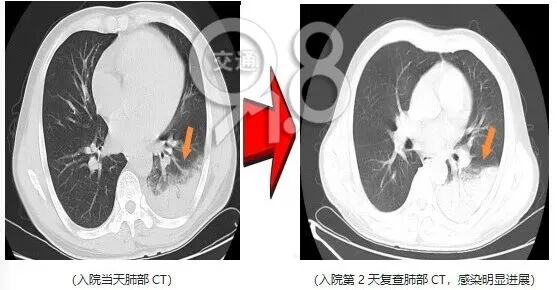 无基础病史，男子高热、咯血！医生：元凶是家里那只鸟