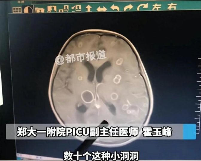 6岁女童发烧17天，脑子被啃出十几个洞，家里这种情况要注意！