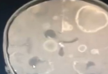 6岁女童发烧17天，脑子竟被“啃”出十几个洞，医生紧急提醒：小心霉菌“爬”进脑子