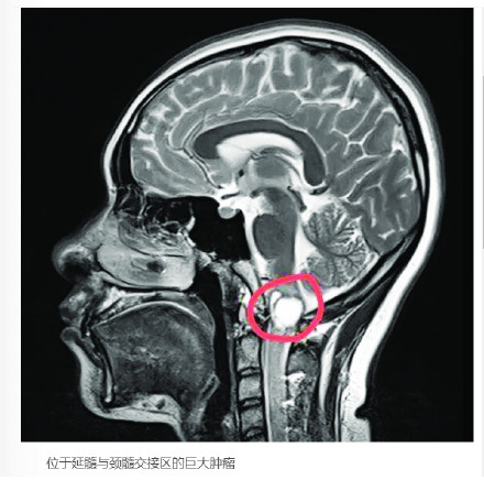 00后女孩莫名头痛两周确诊脑肿瘤