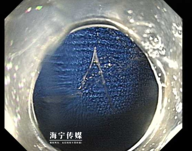 鱼刺卡喉，45岁男子吞菠萝蜜试图带下，结果……想想都可怕