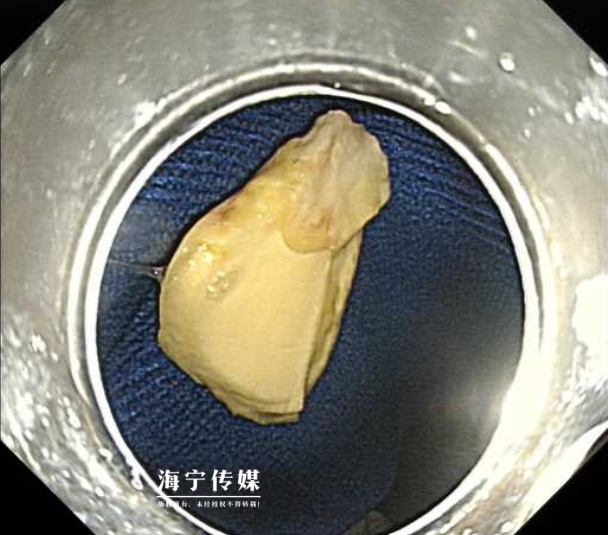 鱼刺卡喉，45岁男子吞菠萝蜜试图带下，结果……想想都可怕