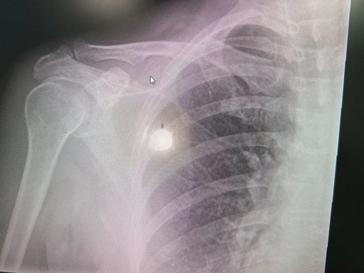 扫个灰锁骨“断”了？竟是因为肿瘤！一年前就有“警告”