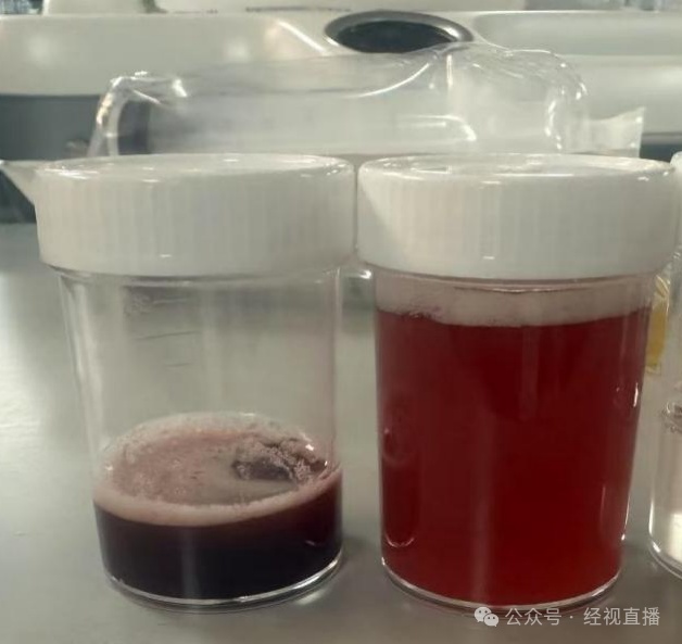 爷爷误将火锅燃料当水冲感冒药，孙子喝下后多器官衰竭进ICU！父亲崩溃：心都碎了