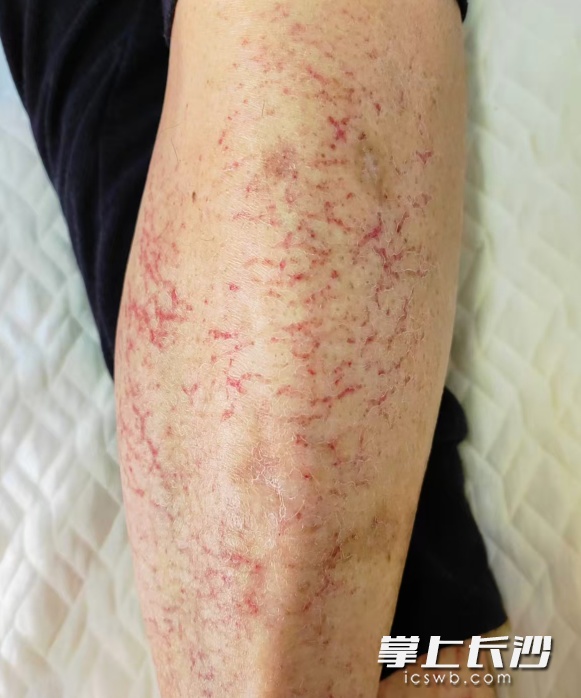 女子连续3天在电暖麻将桌玩牌，双腿出现红斑，医生：不管它会出现水疱，甚至癌变