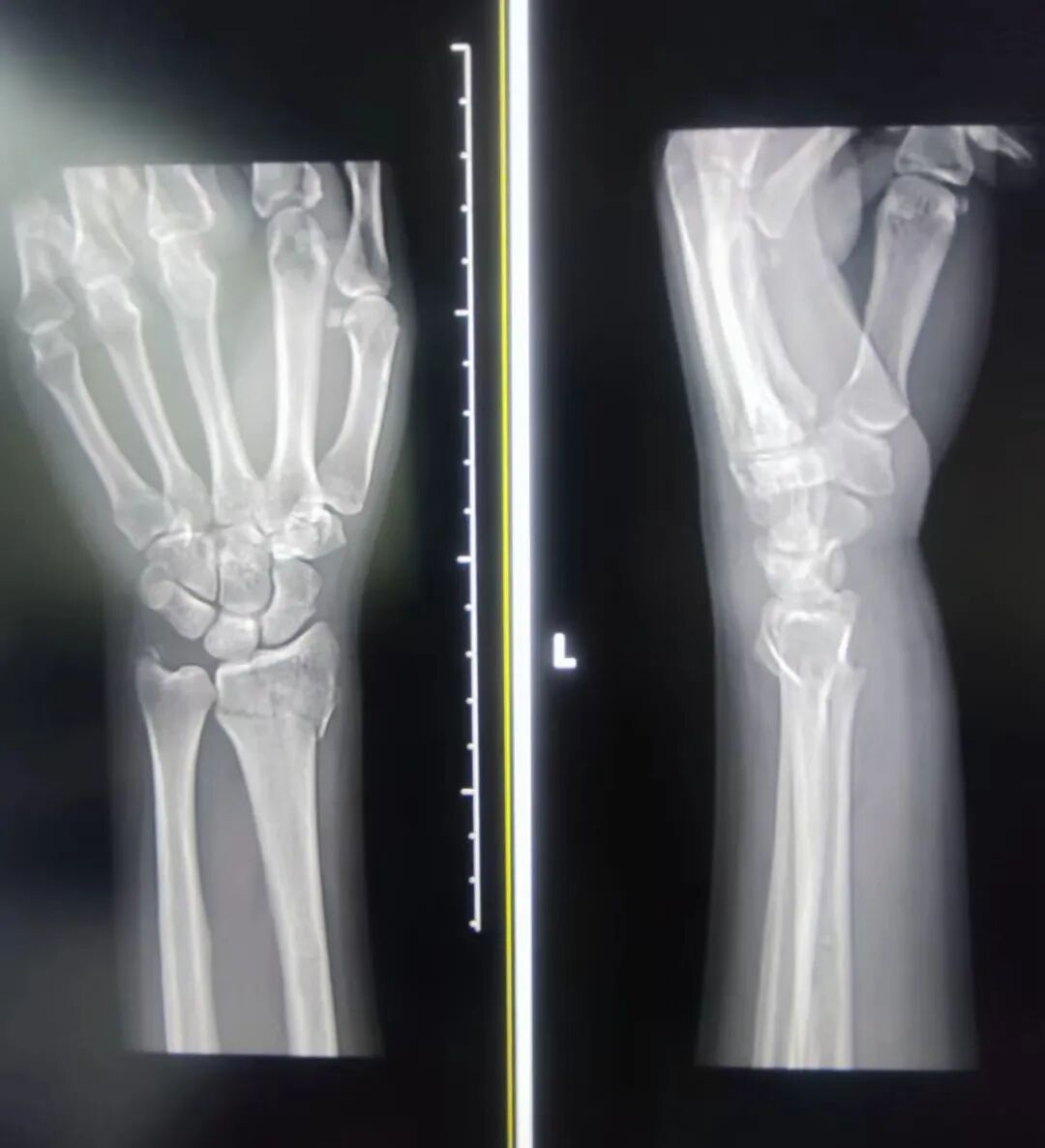 浙江初雪后，第一波骨折的人来急诊“报到”了！医生：今早接诊多个，“骨折潮”来了