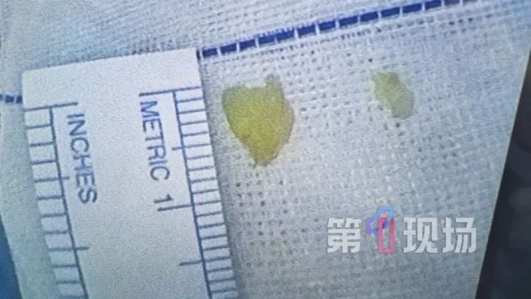 一岁娃吃苹果后哭闹，果渣不慎呛入气管！这些进食事项要注意