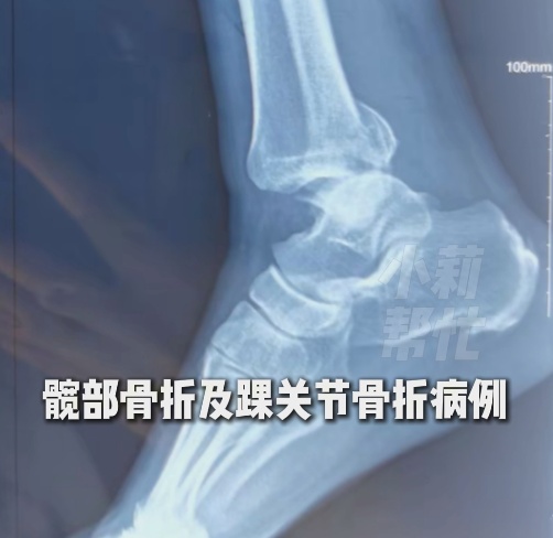 郑州一医院连续两天接诊近200名骨折患者！医生提醒：这几件事一定要做对能缓解影响