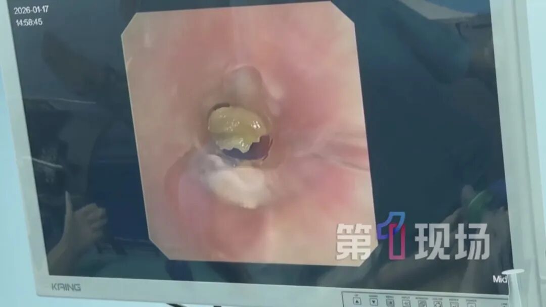 一岁娃吃苹果后哭闹，果渣不慎呛入气管！这些进食事项要注意