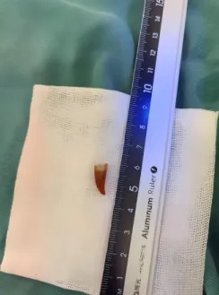 55岁阿姨莫名咳嗽近4个月，吃什么药都没用……这个坏习惯很多人都有，上海专家提醒→