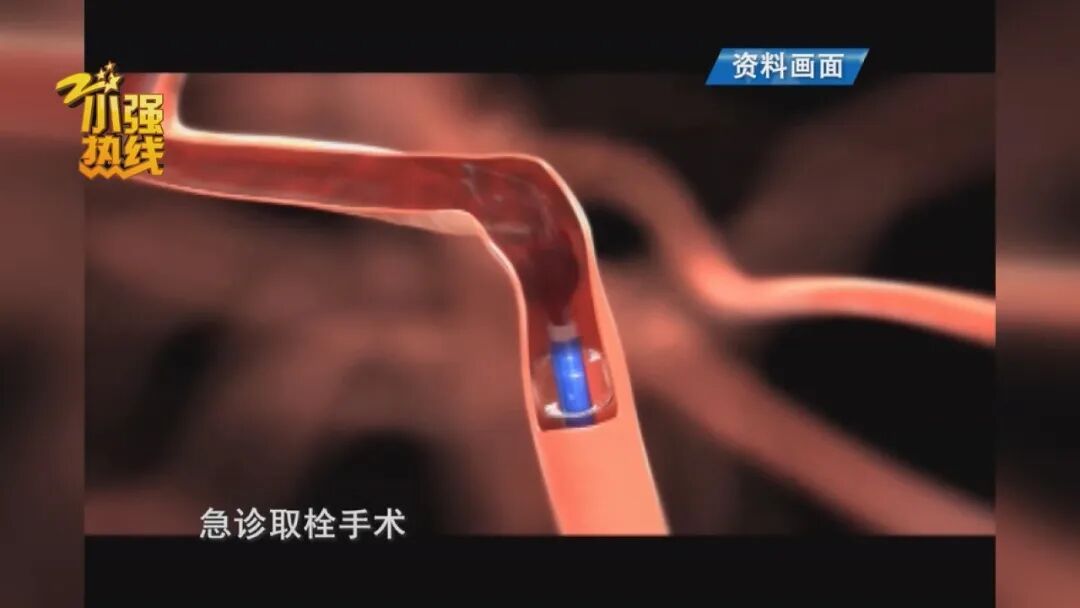 65岁男子一觉醒来身体无法动弹!医生提醒:低温天是高发期 65岁男子一觉醒来身体无法动弹!医生提醒:低温天是高发期