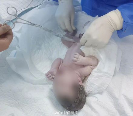 腹痛入院知怀胎十月 女子已成功分娩
