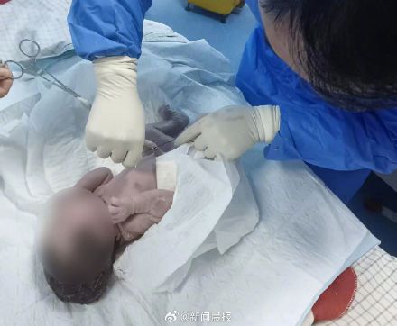 腹痛入院知怀胎十月 女子已成功分娩