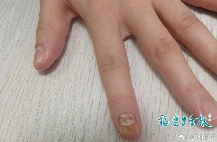 指甲像被“吃”了一半！ 女子自行美甲同时感染细菌和真菌