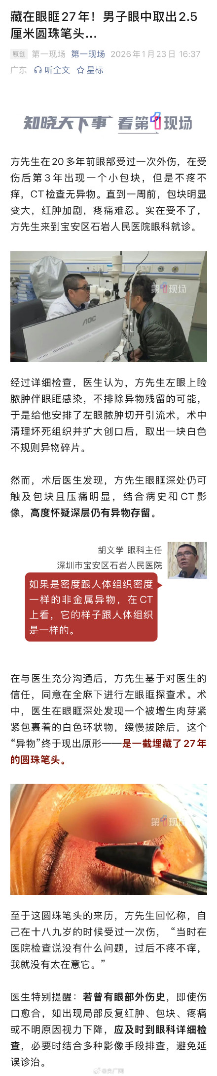 2.5cm圆珠笔头藏男子眼眶27年