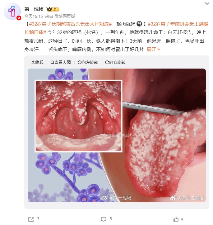 男子起床后吓出一身冷汗,舌头长出大片“奶皮”!这种生活习惯真的要改 男子起床后吓出一身冷汗,舌头长出大片“奶皮”!这种生活习惯真的要改