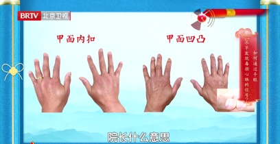 手掌出现这种褶皱，要关注自己的心脏