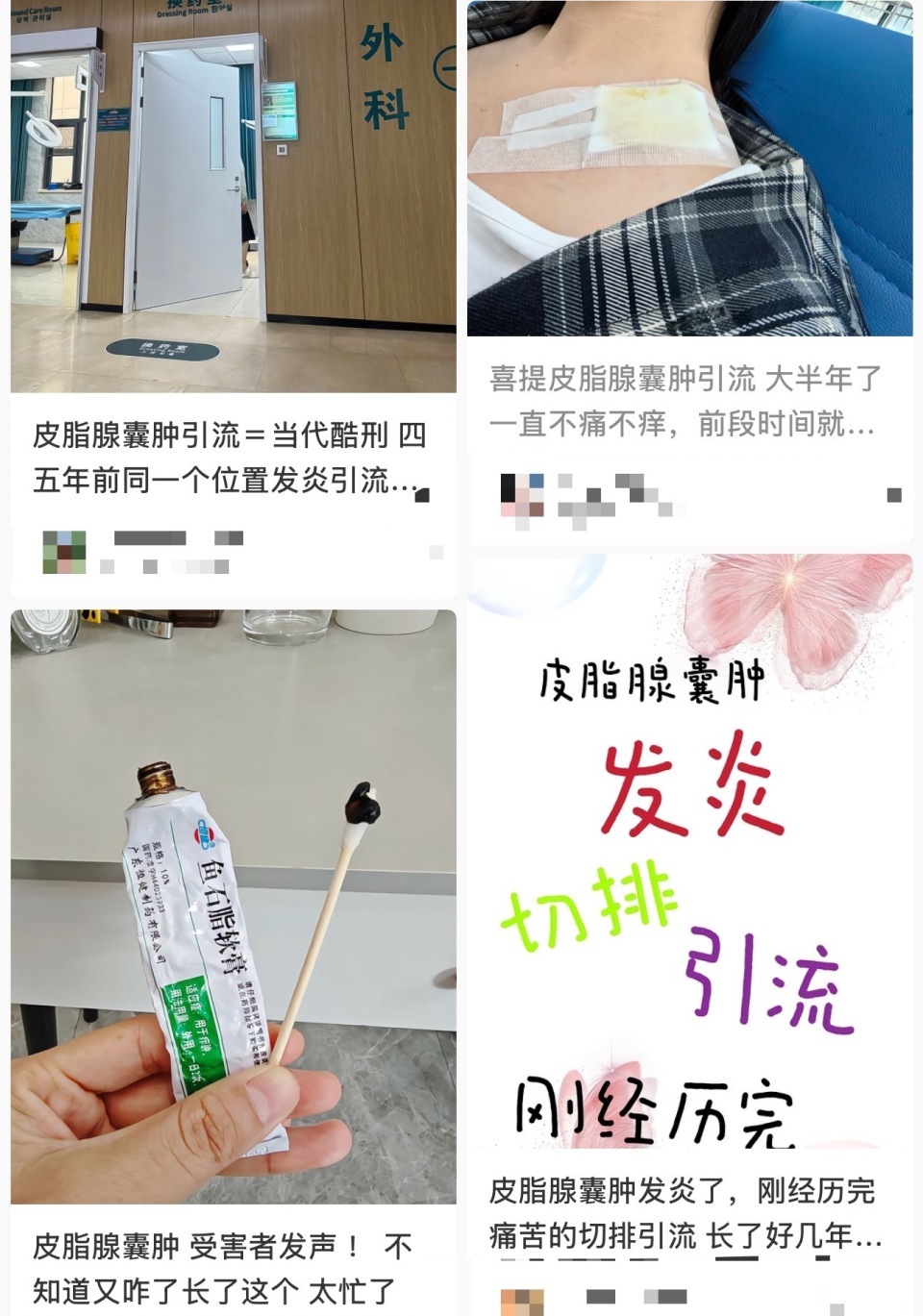 网友分享“像挤痘痘一样暴力挤皮脂腺囊肿”经验,医生:易化脓破溃!除了复发还会留疤 网友分享“像挤痘痘一样暴力挤皮脂腺囊肿”经验,医生:易化脓破溃!除了复发还会留疤