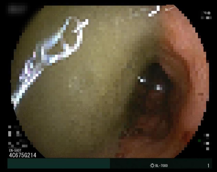 腹胀12天,72岁老人肠道竟堵直径10cm的粪石,广州医生巧施“碎石术” 腹胀12天,72岁老人肠道竟堵直径10cm的粪石,广州医生巧施“碎石术”