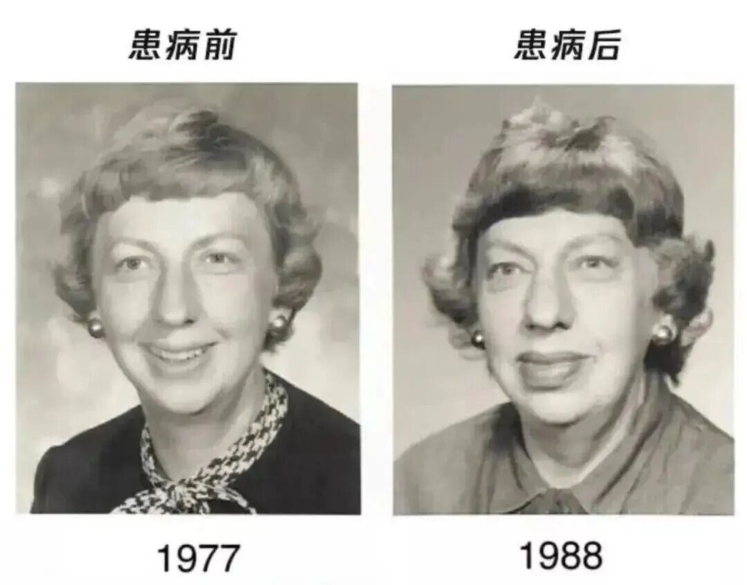 这种面相可能是肿瘤前兆！别以为只是“发福”了